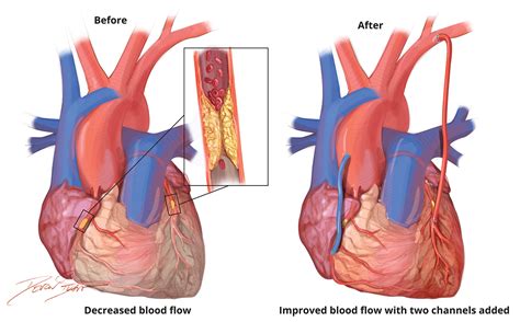 Coronary Artery Bypass Graft Surgery Johns Hopkins Medicine Coronary Artery Bypass Graft Surgery Johns Hopkins Medicine