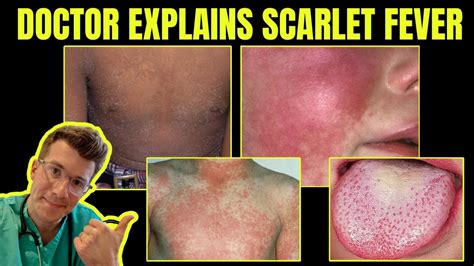 Doctor Explains Scarlet Fever Group A Streptococcal Disease Causes Symptoms Treatment Youtube