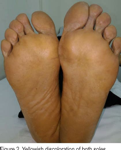 Image Diagnosis Yellow Palms And Soles Look Beyond The Eyes And Think Beyond Hyperbilirubinemia The Permanente Journal Image Diagnosis Yellow Palms And Soles Look Beyond The Eyes And Think Beyond Hyperbilirubinemia The Permanente Journal