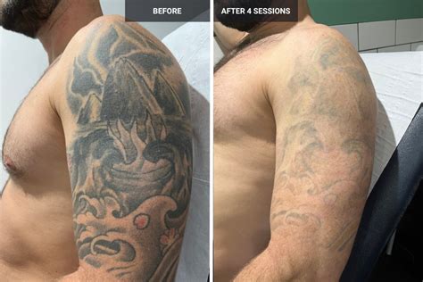 Laser Tattoo Before And After
