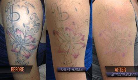 Tattoo Removal Results In Round Rock Tx Clean Slate Ink