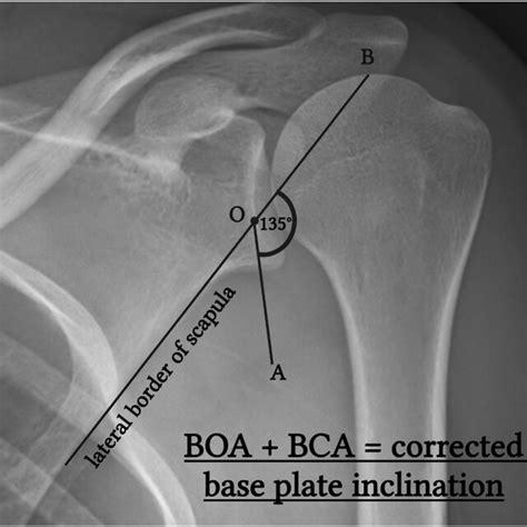 The Base Plate Orientation Angle A Plain Radiographic Technique For The Base Plate Orientation Angle A Plain Radiographic Technique For